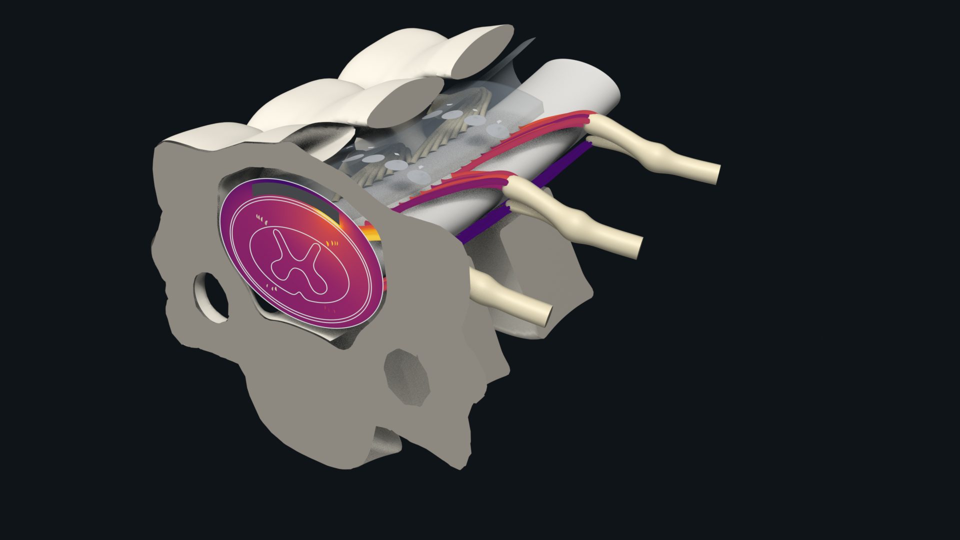 A cervical vertebra cut across. In its canal the cut is coloured by the electric potential, brightest under one contact of a see-through paddle; behind it, between cut-open vertebrae, the rootlets of three nerve roots are coloured by the current at which they respond.