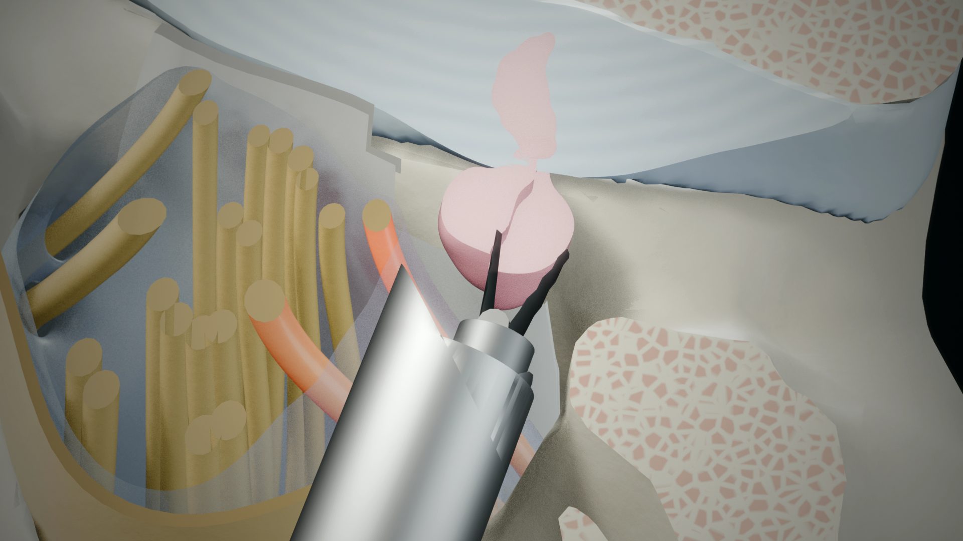 Cut-away of the spinal canal at L4/L5. Grasping forceps reach out of a steel working sheath and close on a pink disc fragment beside the nerve roots; the compressed L5 root is red.
